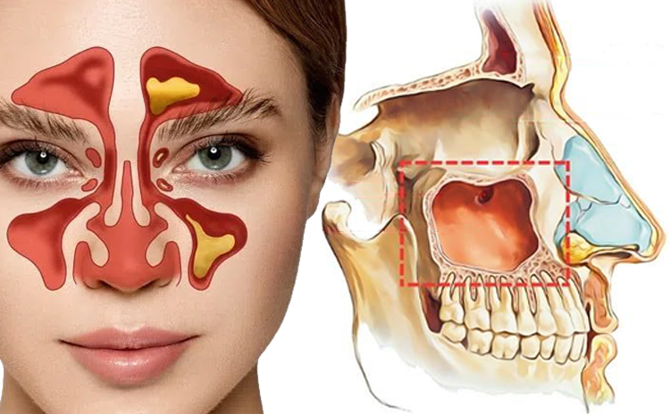 Viêm xoang hàm là gì? Nguyên nhân, triệu chứng và những phương pháp điều trị người bệnh nên biết